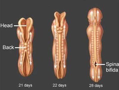 Bảo Vệ Trẻ Khỏi Nguy Cơ Dị Tật Ống Thần Kinh