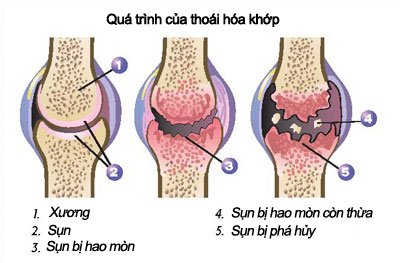 Cải Thiện Bệnh Thoái Hóa Khớp Bằng Thực Đơn Hàng Ngày