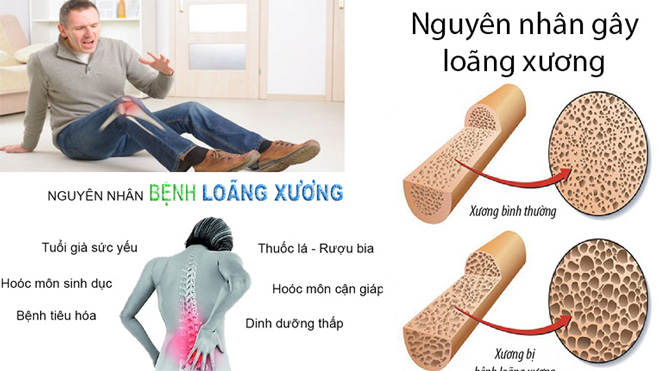 Nguyên nhân dẫn tới loãng xương.