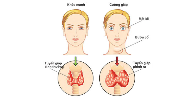 ung thư tuyến giáp