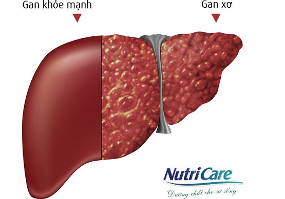 Gan Và Những Bệnh Thường Gặp