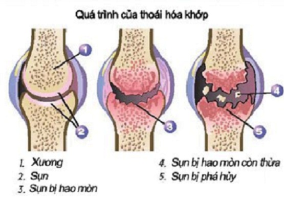 Cải Thiện Bệnh Thoái Hóa Khớp Bằng Thực Đơn Hàng Ngày