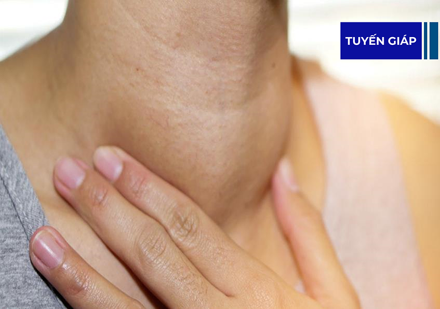 Cường giáp – bệnh lý ít được quan tâm nhưng không thể bỏ qua