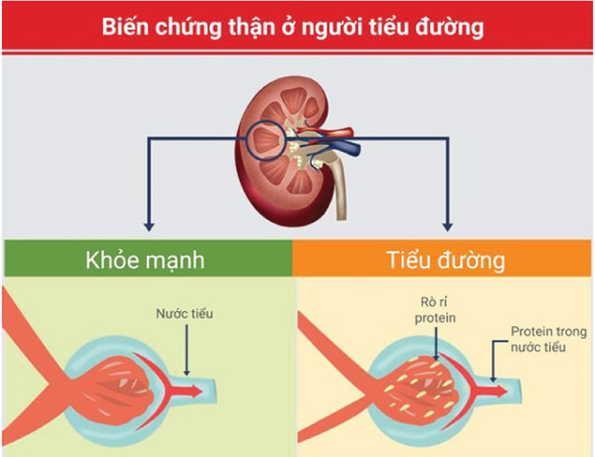 Bệnh tiểu đường gây khiến gây nên bệnh thận mãn tính