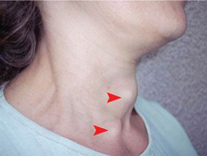 Khối u xuất hiện ở tuyến giáp