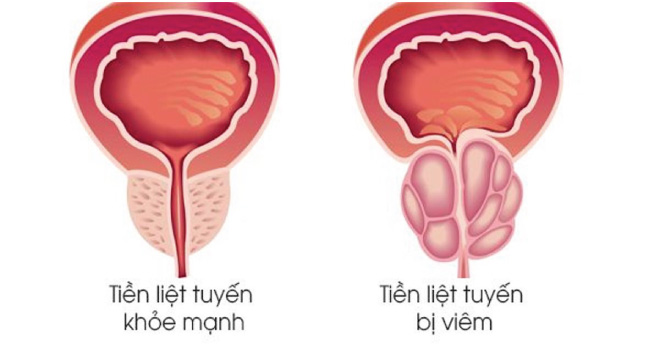 Viêm tiền liệt tuyến