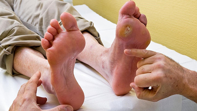 Biến chứng biểu hiện trên bàn chân