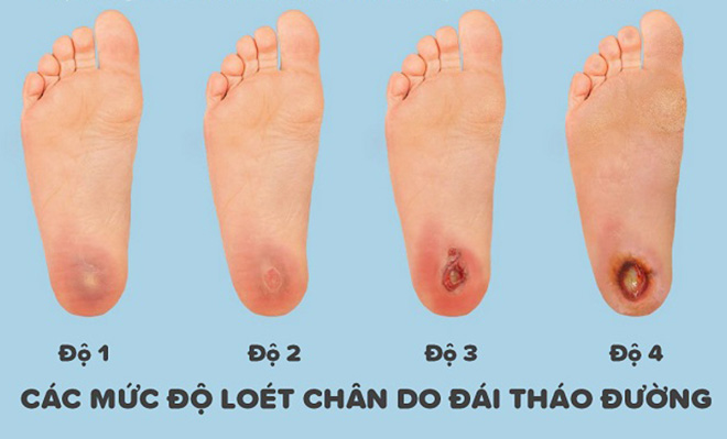 Đánh giá mức độ loét bàn chân tiểu đường