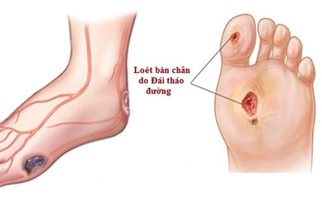 Loét bàn chân
