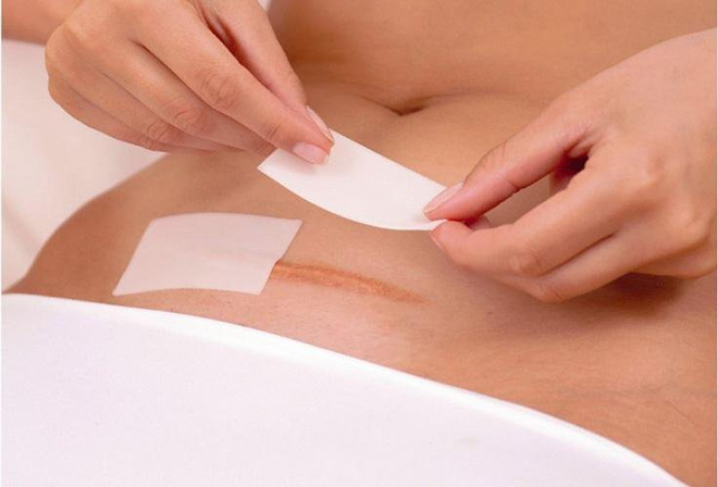 Chăm sóc vết mổ đúng cách