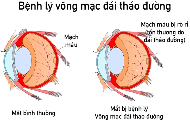Bệnh lý võng mạc tiểu đường
