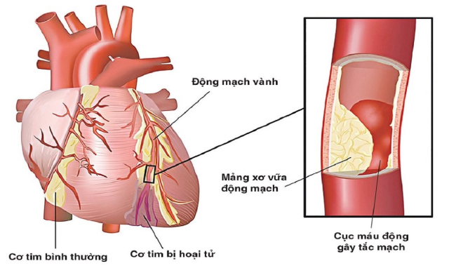 Biến chứng bệnh mạch vành