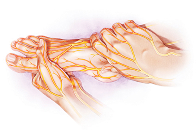 Biến chứng thần kinh ngoại vi
