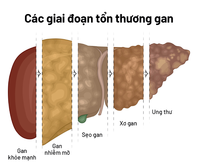 Các giai đoạn tổn thương gan