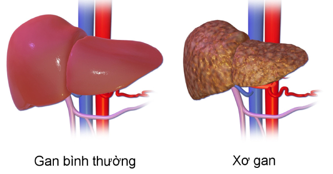 Giai đoạn xơ gan