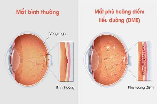 Mắt biến chứng phù hoàng điểm