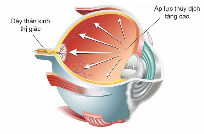 Tăng nhãn áp ở người tiểu đường