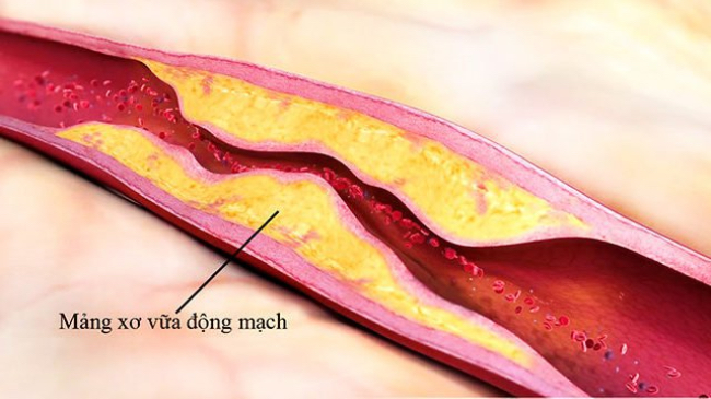 Xơ vữa động mạch