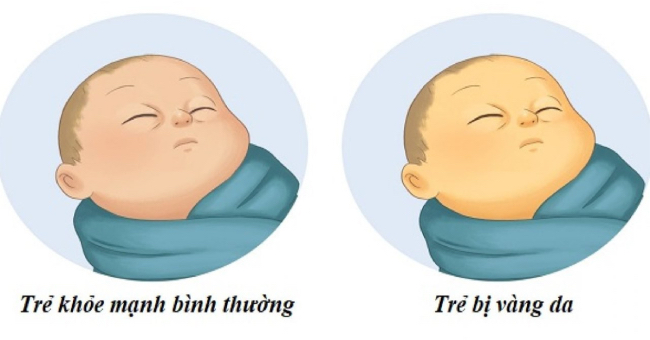Vàng da ở trẻ sơ sinh