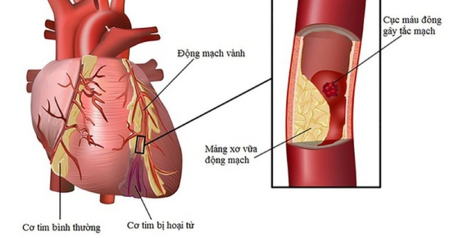 Nguy cơ mắc bệnh tim mạch